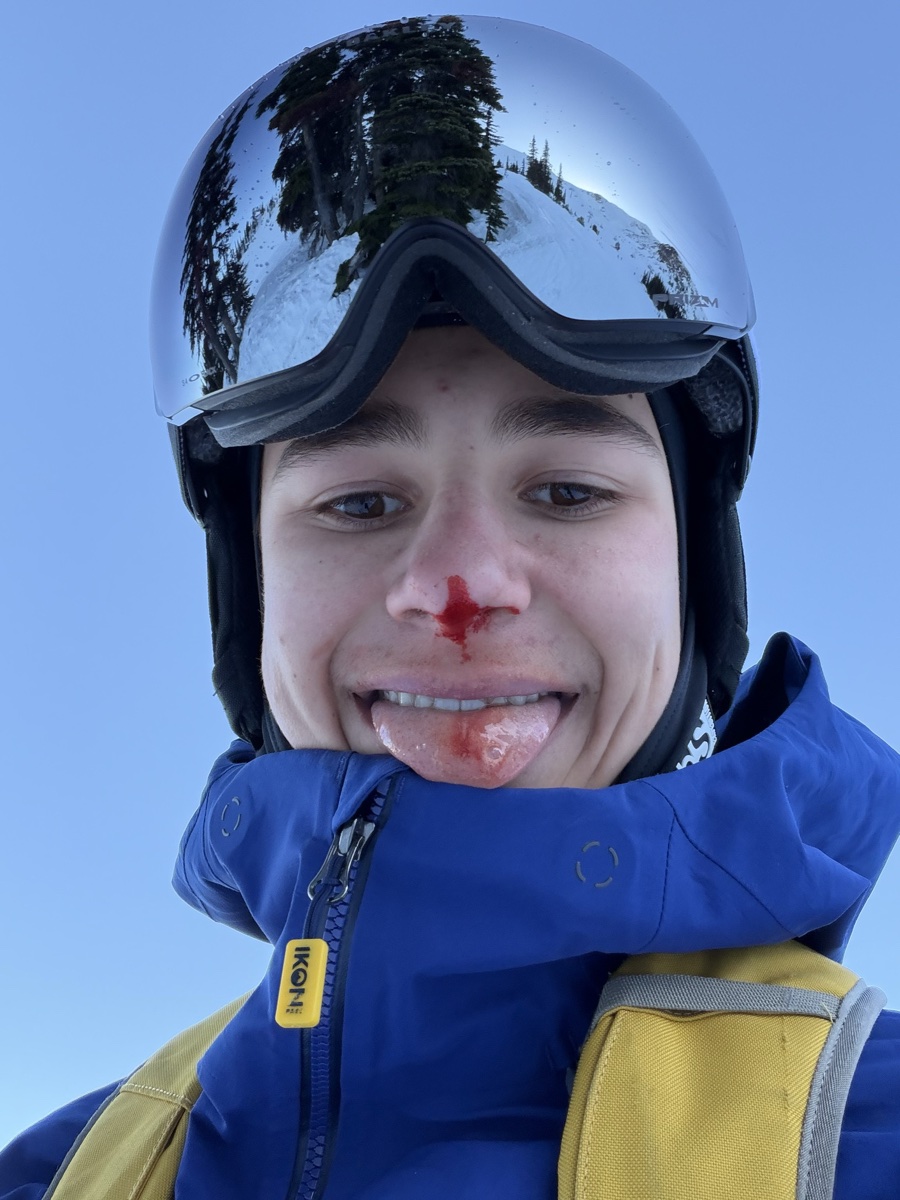 Eli in a blue ski jacket and goggles with a bloody nose
